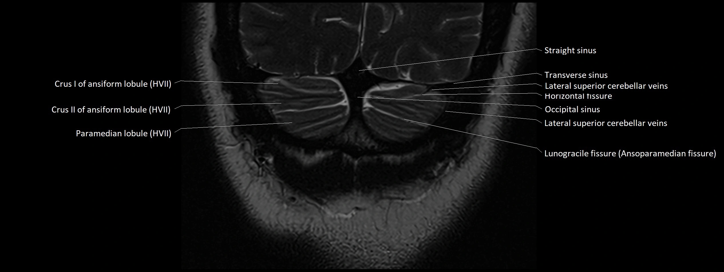 Anatomy of cerebellum coronal cross sectional 3T image 30.webp